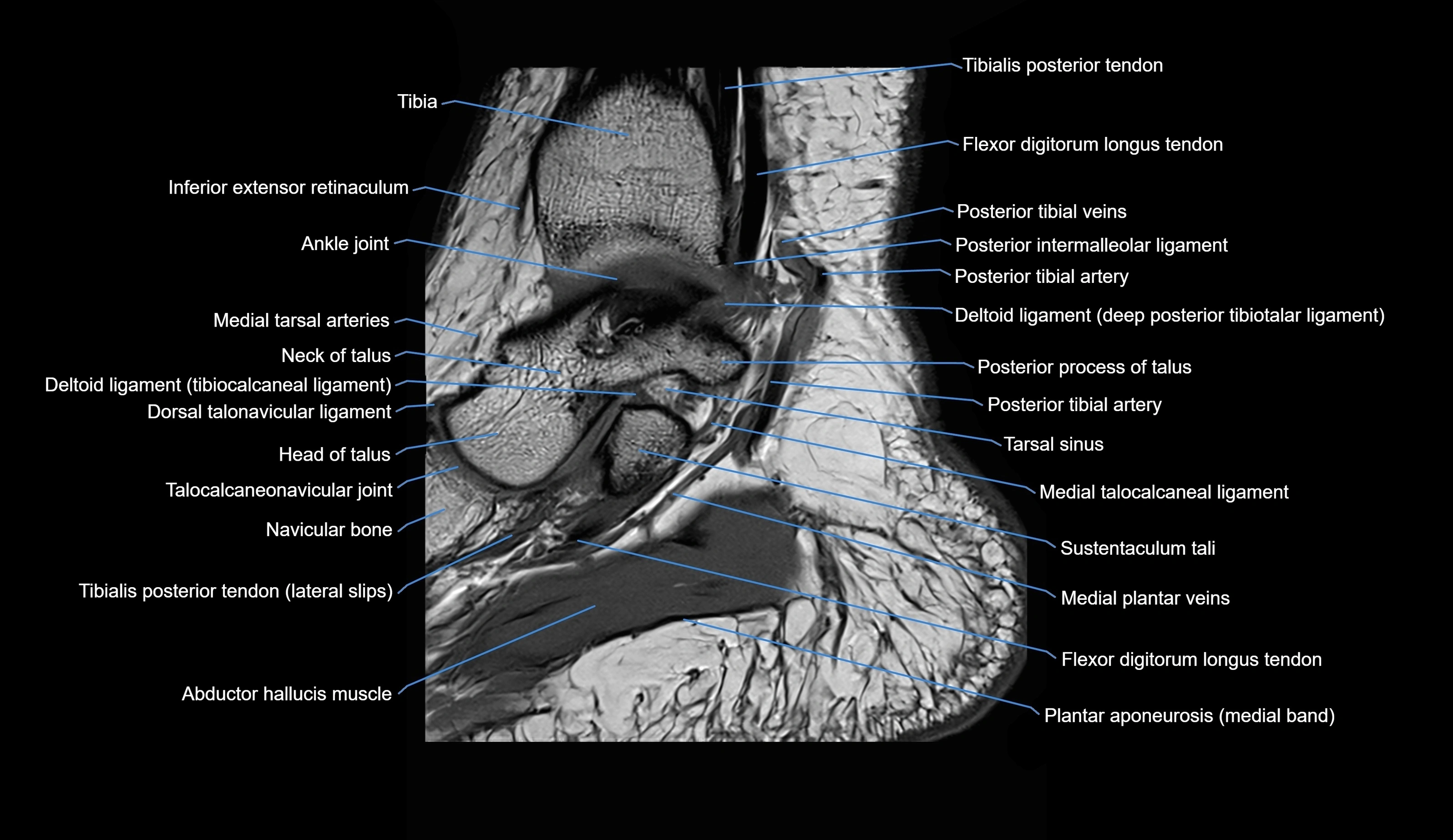 MRI Ankle sagittal cross sectional anatomy 3T  radiology  image-img-00001-00009.webp